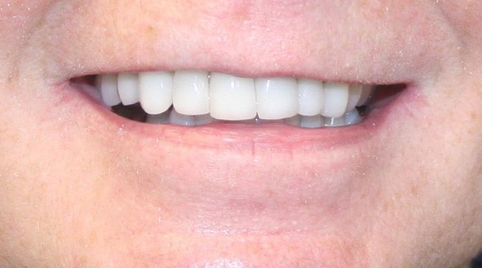 After - Staly Dental