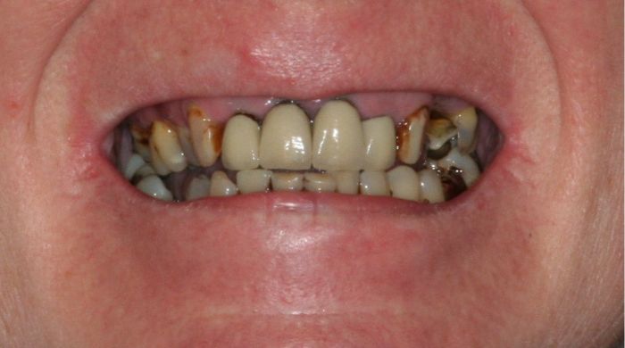 Before - Staly  Dental