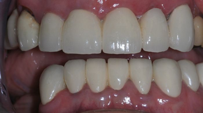 After - Staly Dental