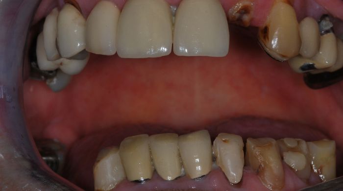 Before - Staly  Dental