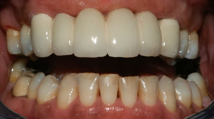 After - Staly Dental