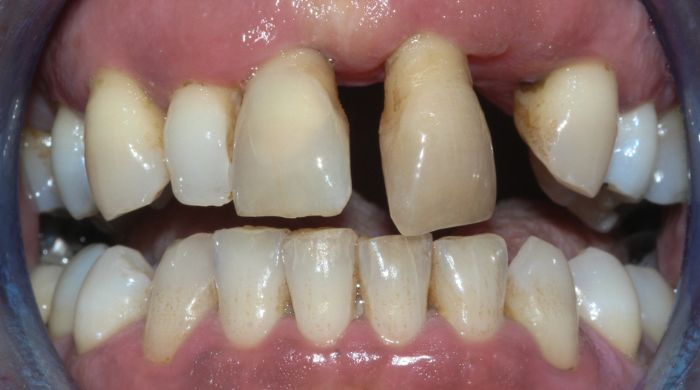 Before - Staly  Dental