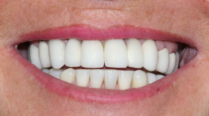 After - Staly Dental