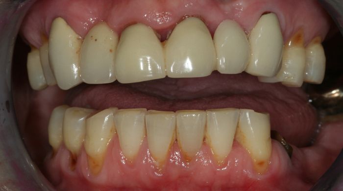 Before - Staly  Dental