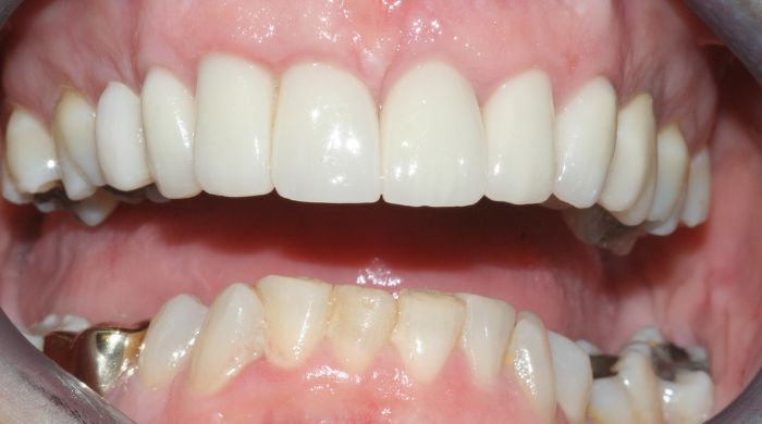 After - Staly Dental