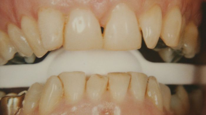 Before - Staly  Dental