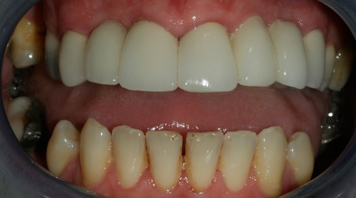 After - Staly Dental