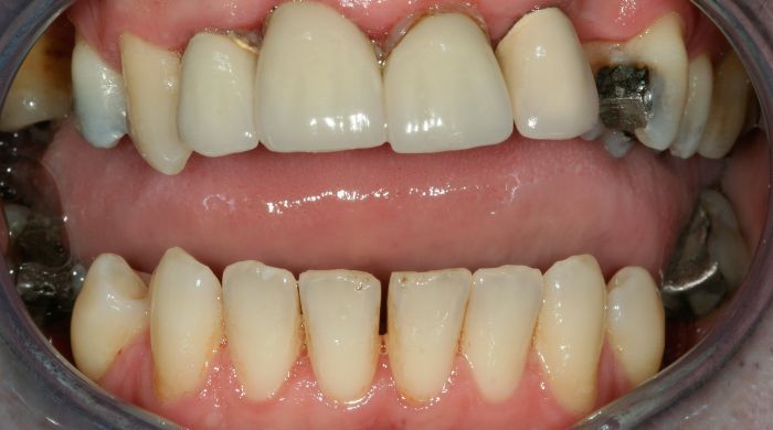 Before - Staly  Dental