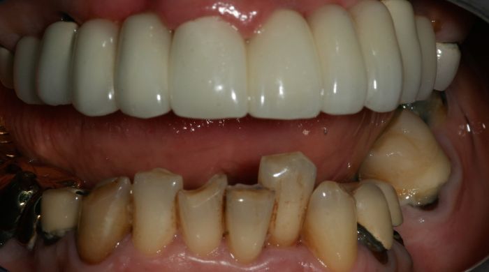 After - Staly Dental