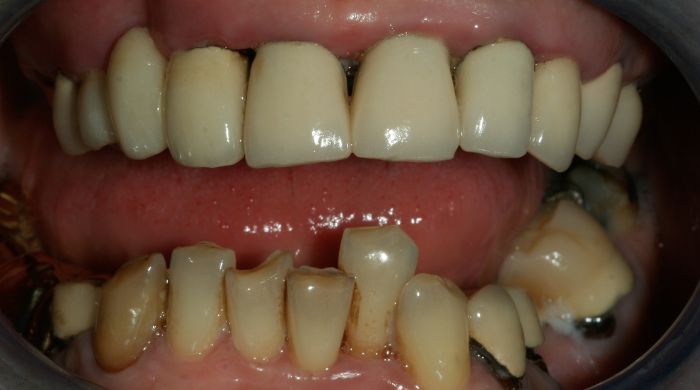 Before - Staly  Dental