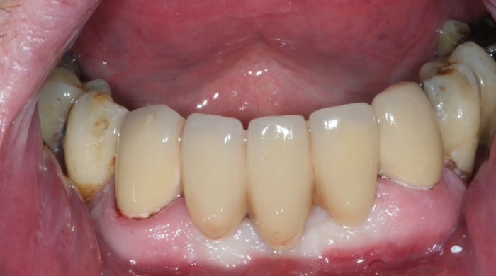 After - Staly Dental