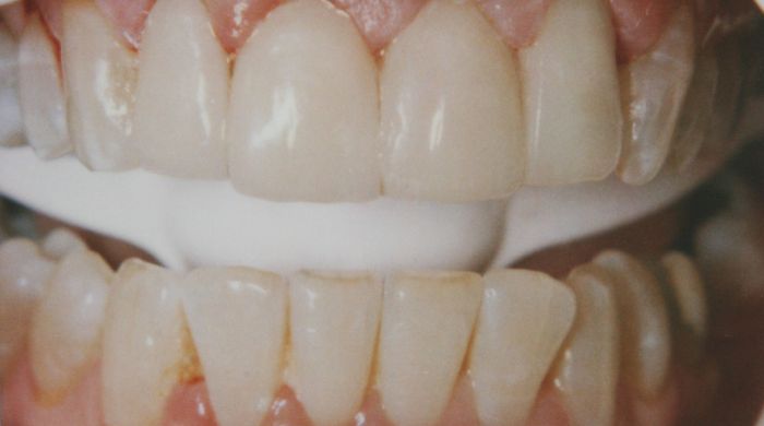 After - Staly Dental