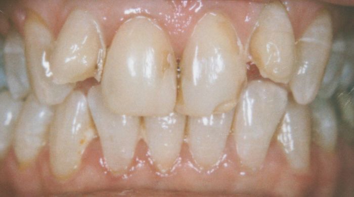 Before - Staly  Dental