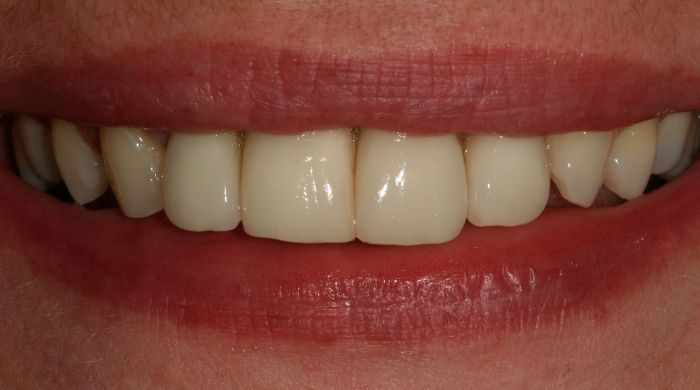 After - Staly Dental