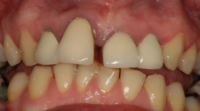 Before - Staly  Dental