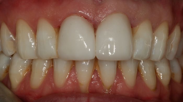 After - Staly Dental