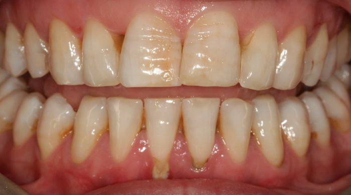 Before - Staly  Dental