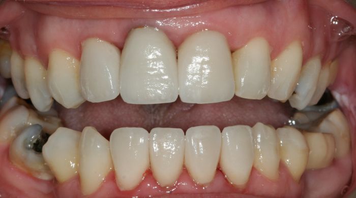 After - Staly Dental