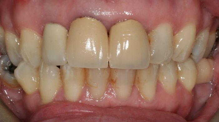 Before - Staly  Dental