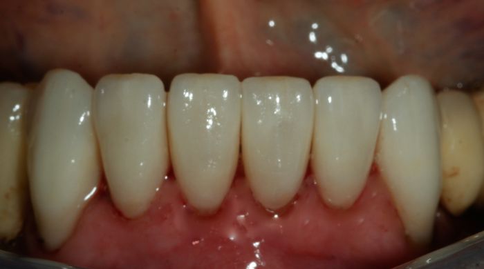 After - Staly Dental