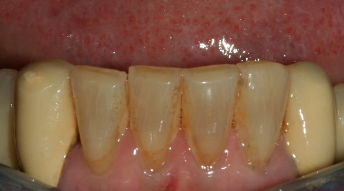 Before - Staly  Dental