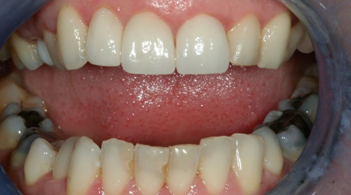 After - Staly Dental