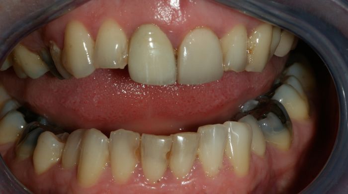 Before - Staly  Dental