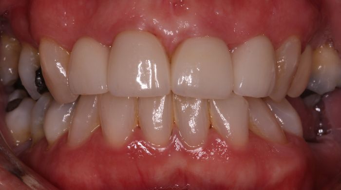 After - Staly Dental