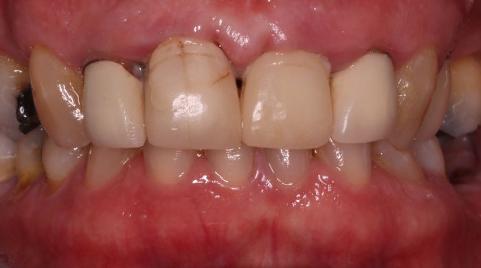 Before - Staly  Dental