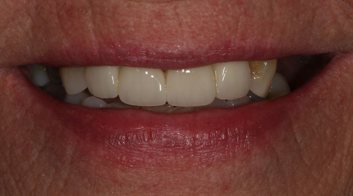 After - Staly Dental