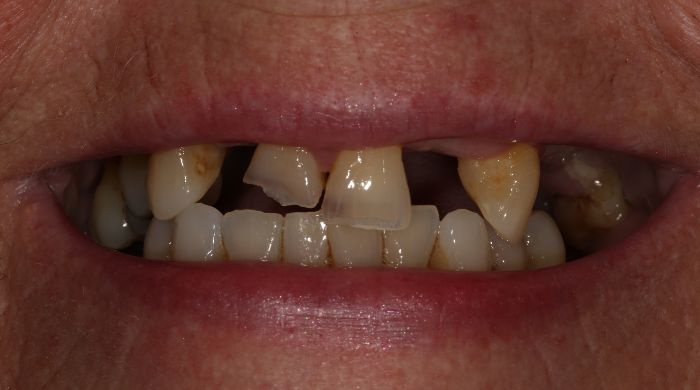 Before - Staly  Dental