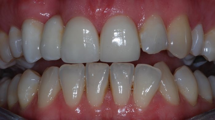 After - Staly Dental