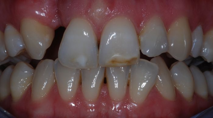 Before - Staly  Dental