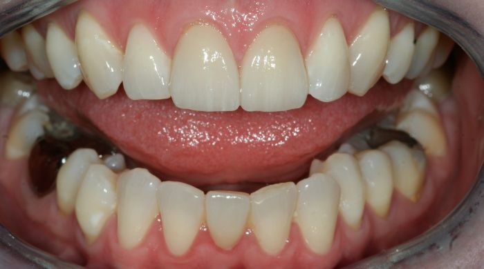 After - Staly Dental