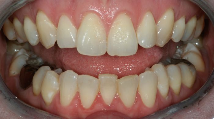 Before - Staly  Dental