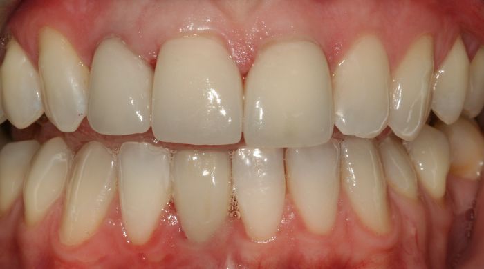 After - Staly Dental