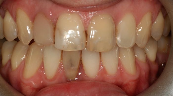 Before - Staly  Dental