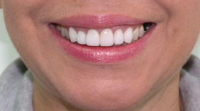 After - Staly Dental