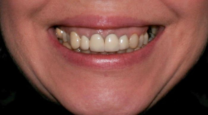 Before - Staly  Dental