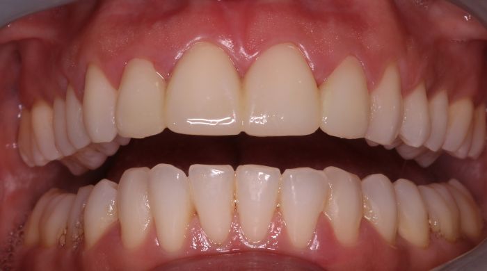 After - Staly Dental