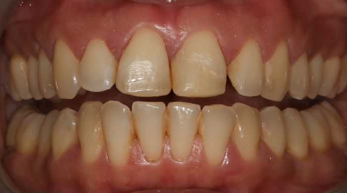 Before - Staly  Dental