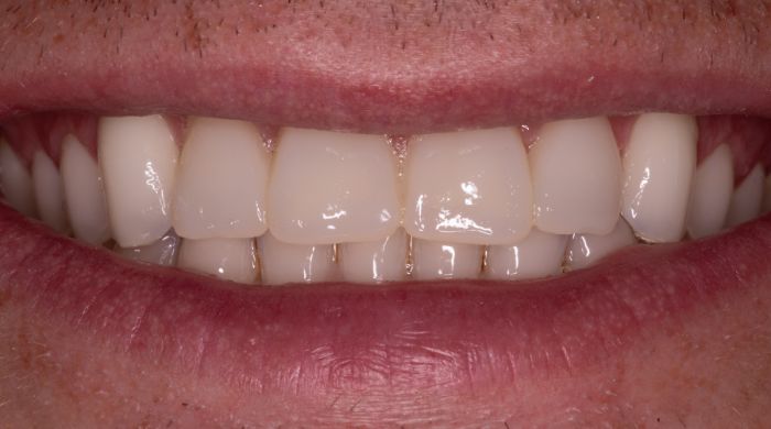 After - Staly Dental