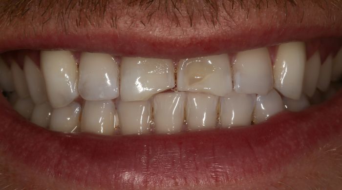 Before - Staly  Dental