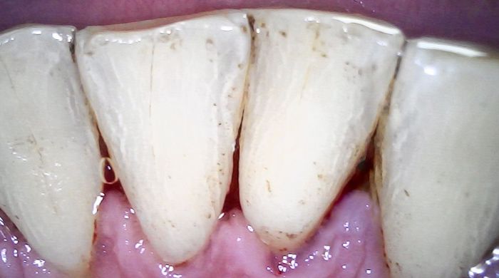 After - Staly Dental