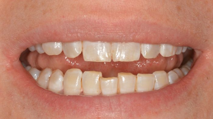 After - Staly Dental