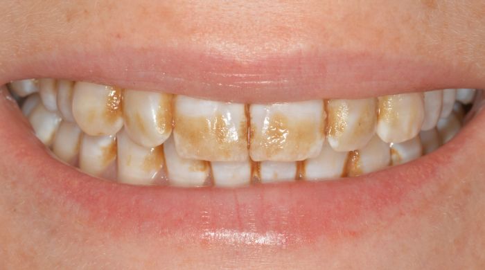 Before - Staly  Dental