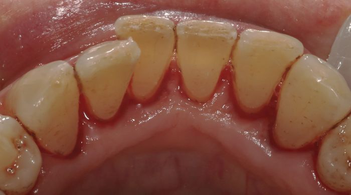 After - Staly Dental