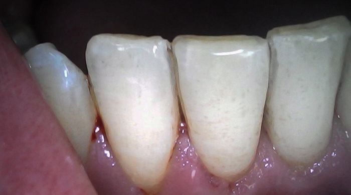 After - Staly Dental