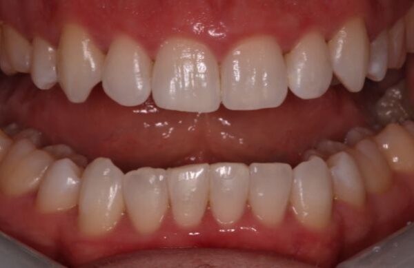 After - Staly Dental