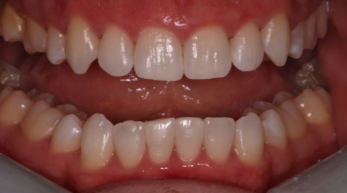 After - Staly Dental